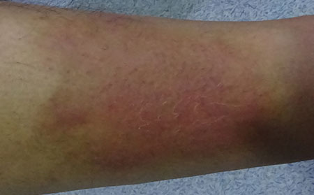 銀屑病應該怎么進行預防