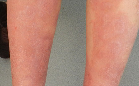 老年銀屑病應(yīng)該怎么用藥