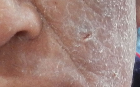 銀屑病的護理方法有什么