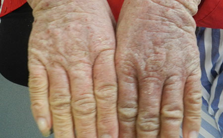 銀屑病的護理方法有什么