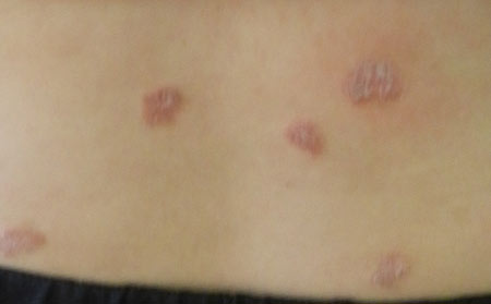 銀屑病應(yīng)該怎么進(jìn)行預(yù)防