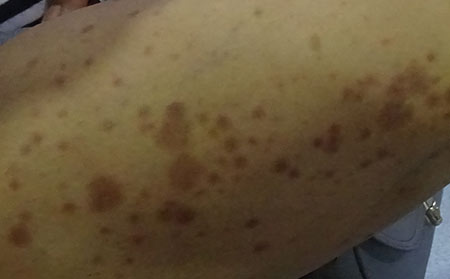 銀屑病發生跟生活習慣有關嗎