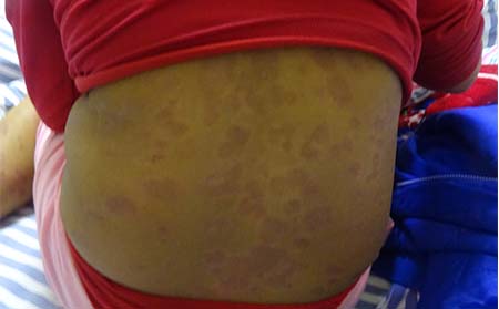 銀屑病應該去哪家醫院治療