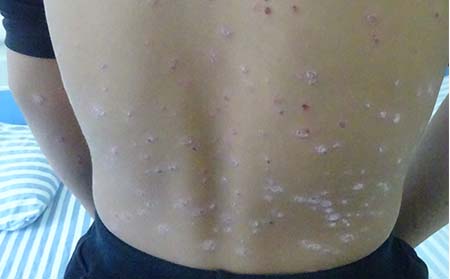 銀屑病的預防方法有什么