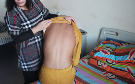 銀屑病怎么就發(fā)生了