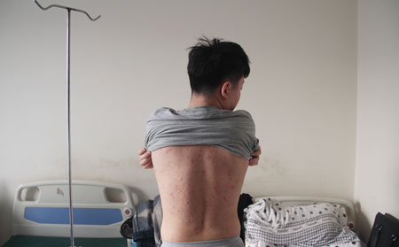 銀屑病患者的日常護(hù)理