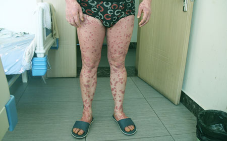 導致銀屑病的原因有什么