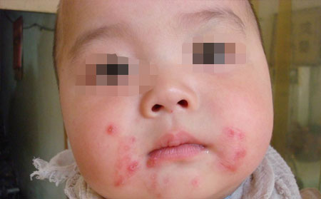 銀屑病應該怎么進行護理