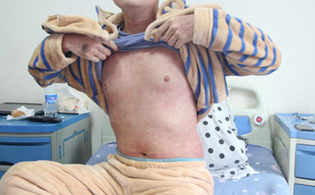 銀屑病的護理方法有什么