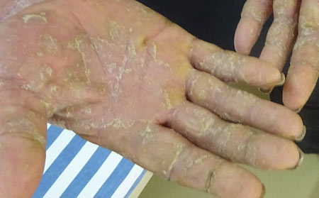 銀屑病應(yīng)該怎么進行護理