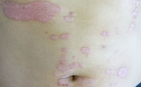 治療銀屑病應(yīng)該去哪家醫(yī)院