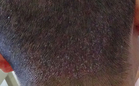 銀屑病應該怎么進行護理