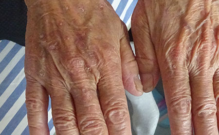 銀屑病的癥狀都有什么