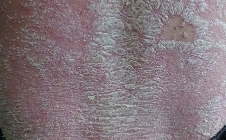 銀屑病患者怎么進行心理調節