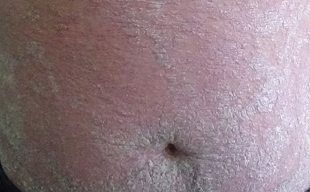 如何預防銀屑病的反復