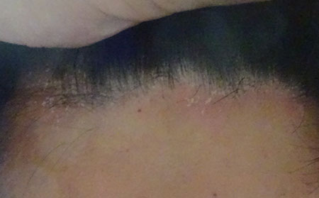 銀屑病為什么會反復