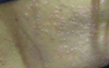 銀屑病患者的心理調(diào)節(jié)