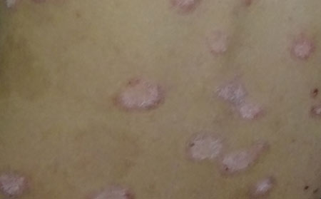 銀屑病應該怎么進行預防