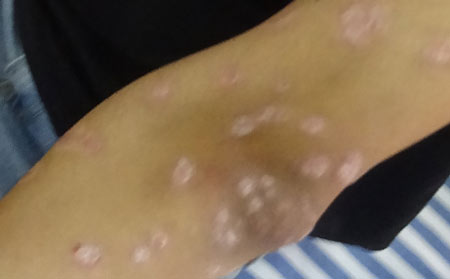 銀屑病的護理方法有什么