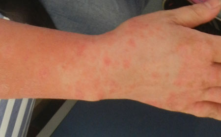 銀屑病應該怎么進行護理