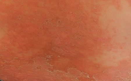 銀屑病應該怎么進行護理