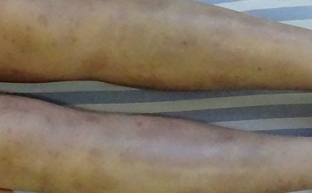 銀屑病應(yīng)該怎么進行治療