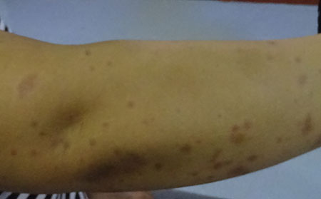 銀屑病的治療方法有什么