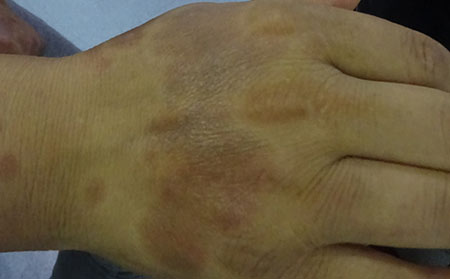 銀屑病應該怎么注意心理健康