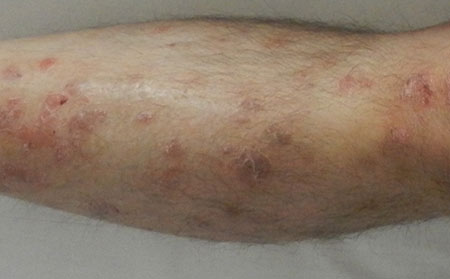 銀屑病應該怎么護理