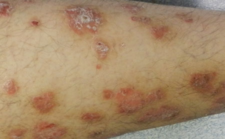 導致銀屑病加重的原因