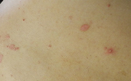 銀屑病應(yīng)該怎么止癢