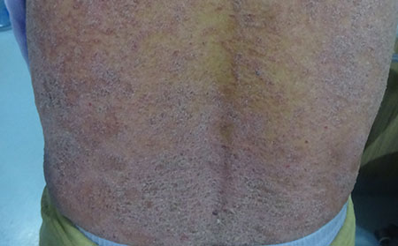 銀屑病發生的原因有什么