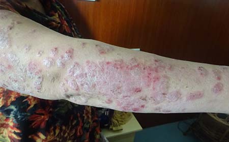 導致銀屑病反復的原因有什么