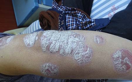 銀屑病在濰坊用什么方法止癢