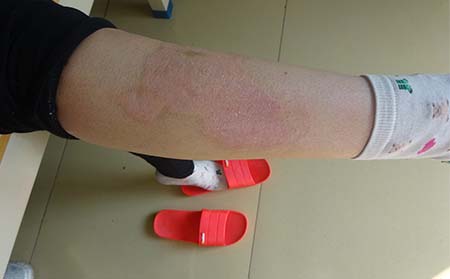 銀屑病患者在濰坊怎么注意心理