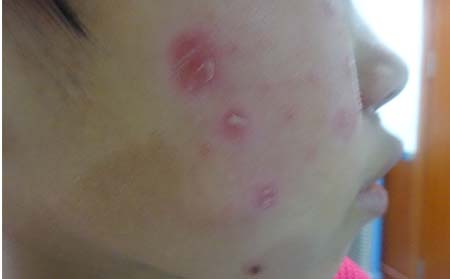 濰坊女性銀屑病患者要慎用化妝品