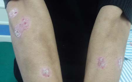 濰坊銀屑病患者應該怎么護理