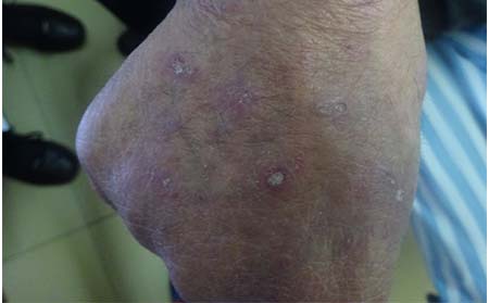 濰坊銀屑病患者心態該怎么調整