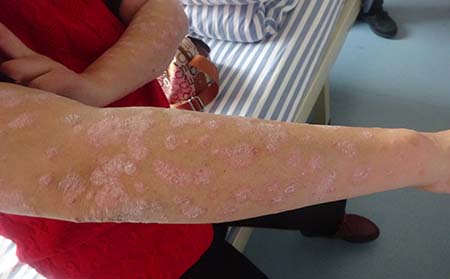 銀屑病對濰坊男性有什么危害