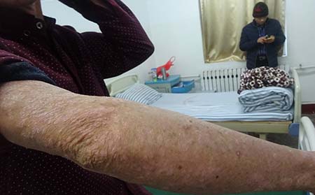 濰坊銀屑病患者應該怎么注意飲食