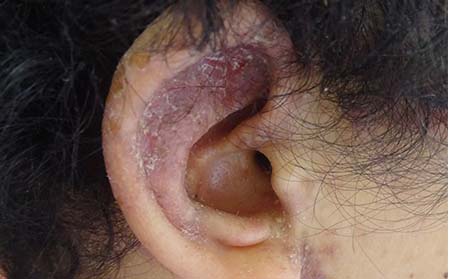 濰坊銀屑病的治療方法有什么