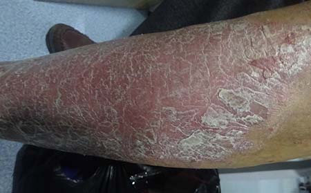 濰坊銀屑病消退的癥狀有什么