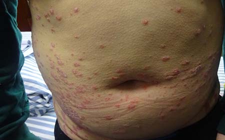 銀屑病在濰坊應該怎么進行護理