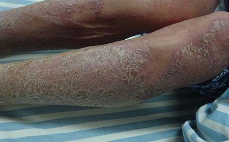 濰坊銀屑病患者應該怎么注意飲食