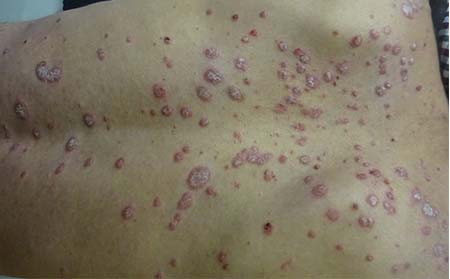 為什么濰坊會(huì)發(fā)生銀屑病