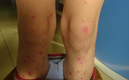 濰坊男性為什么會出現(xiàn)銀屑病