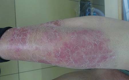 濰坊銀屑病應該怎么進行日常護理