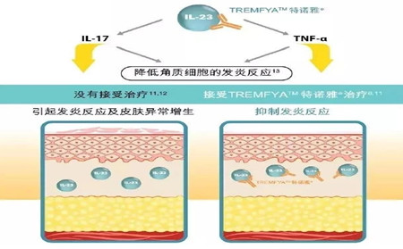 銀屑病新藥,濰坊東方銀屑病研究院