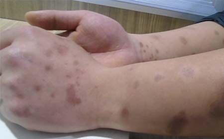 患有牛皮癬后會有什么較為明顯的表現