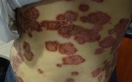 銀屑病癥狀,銀屑病癥狀表現(xiàn)